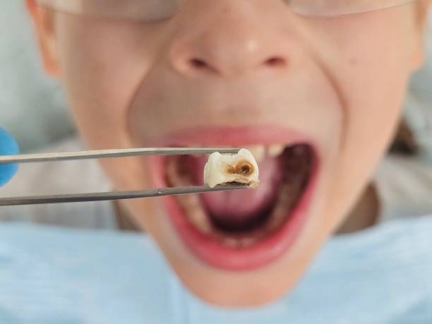 Best Emergency Root Canal Treatment in North Ridgeville, OH